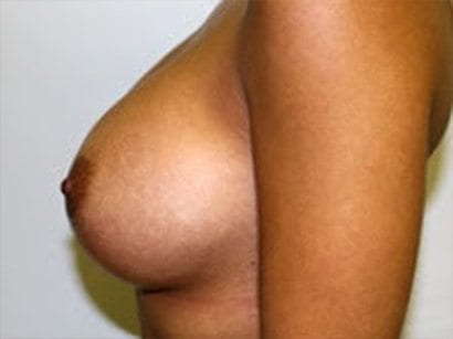 Breast Augmentation