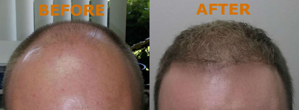 neograft hair transplant