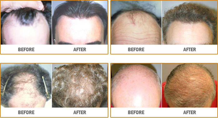 neograft hair transplant