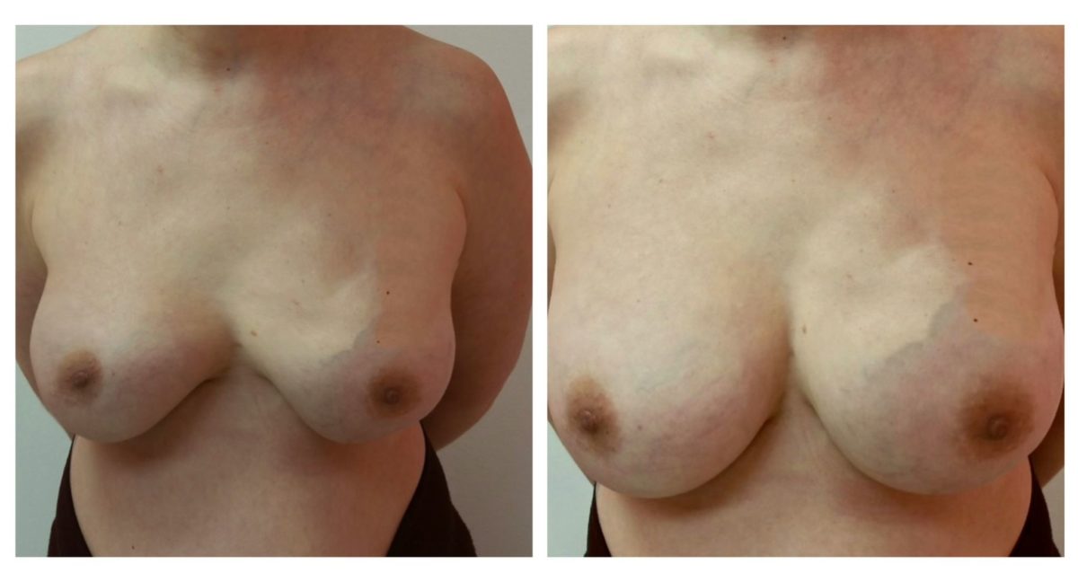 Breast Augmentation