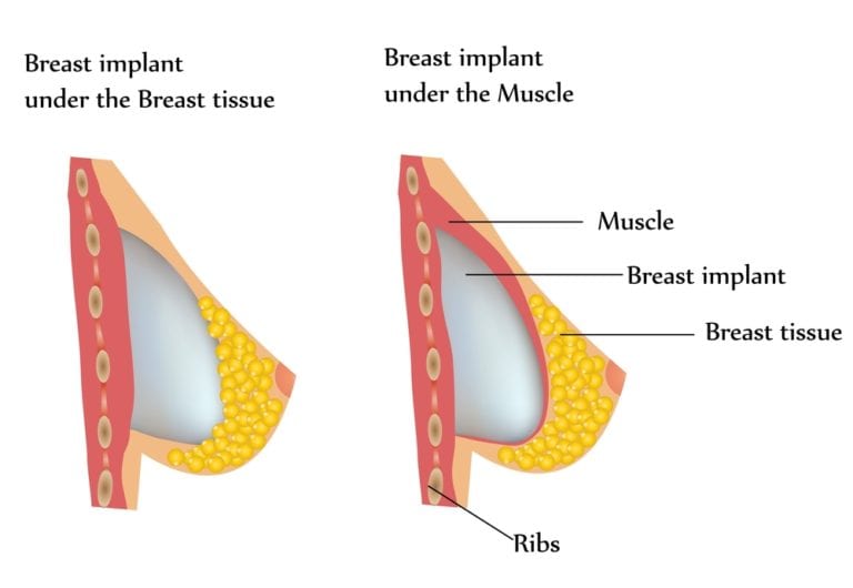 Breast Augmentation