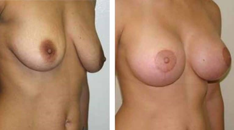 Breast Augmentation before and after