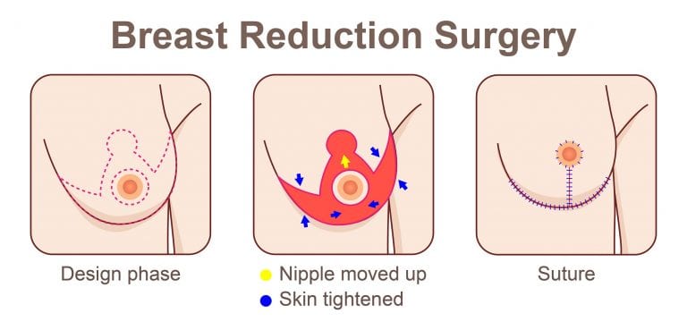 Breast Augmentation