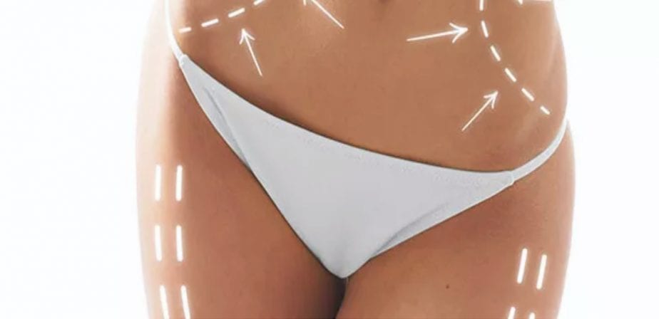 liposuction toronto