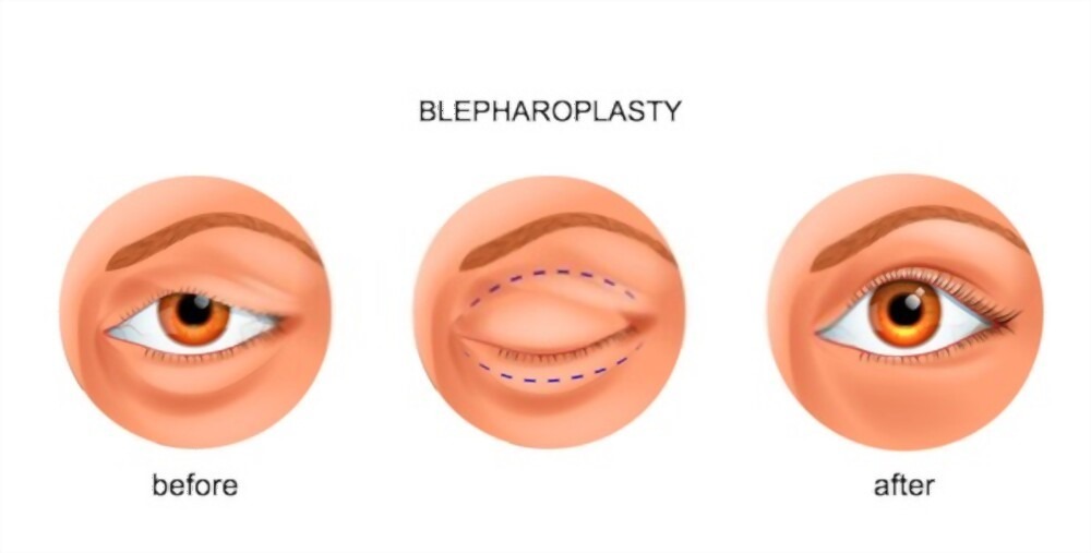 The Benefits of Eyelid Surgery