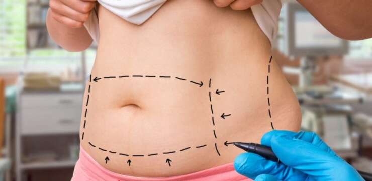 Tummy Tuck