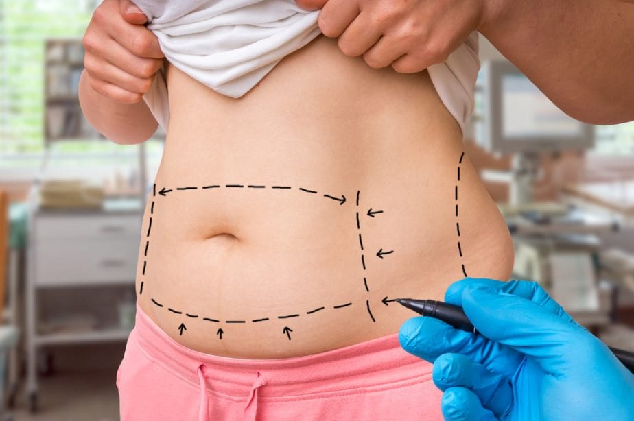 Tummy Tuck