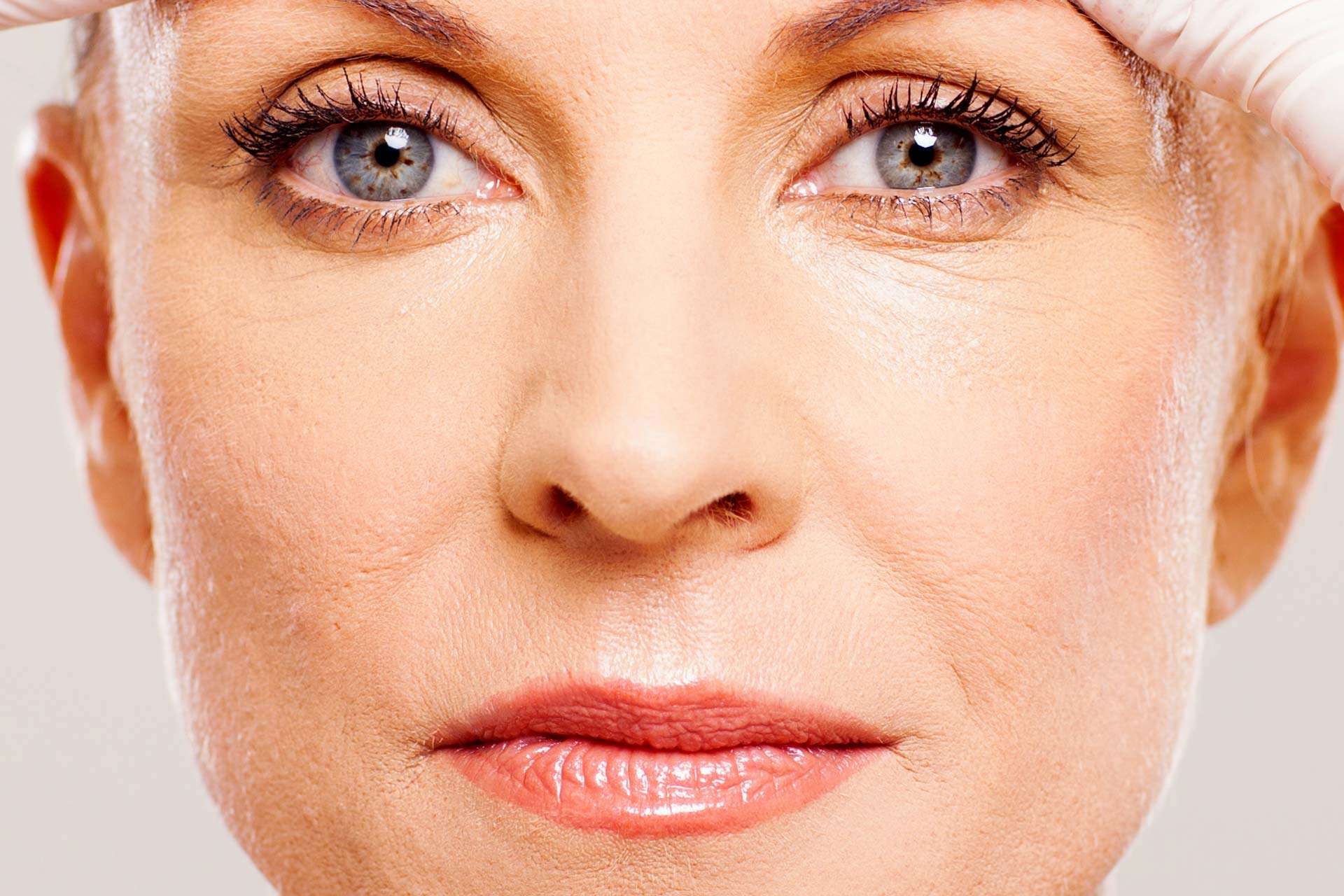 Fractional Resurfacing Lasers Treat Acne Scarring