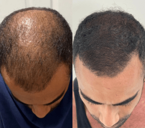 Hair transplant